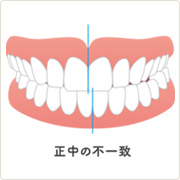 正中の不一致