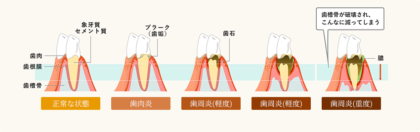 歯周病進行の様子のイラスト