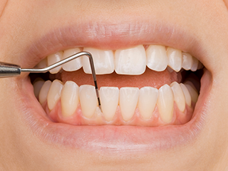 歯周ポケット検査の写真