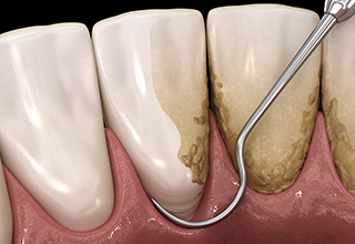 スケーリング・ルート・プレーニング
