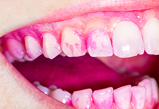 歯垢の染め出し