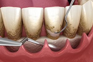 Fop（フラップオペレーション）のイラスト