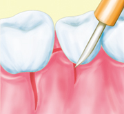 ①歯肉を切開のイラスト