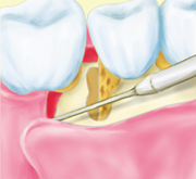 ②軟部組織を剥離のイラスト