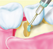 ④エッチング処理のイラスト
