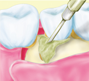 ⑤エムドゲインゲルを塗布のイラスト