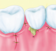 ⑥縫合のイラスト