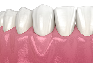 歯肉退縮治療の治療後のイラスト