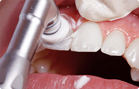 クリーニング（PMTC）