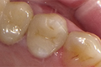 セラミックインレーの治療後
