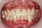 オールセラミッククラウン（ジルコニア）の治療後