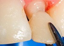 ファイバーコア