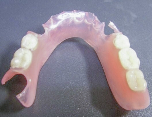 ノンクラスプ（スマイルデンチャー）