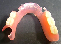 ノンクラスプ（スマイルデンチャー）