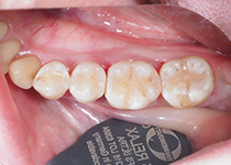 ダイレクトボンディング