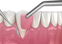 歯冠長延長術・歯肉弁根尖側移動術
