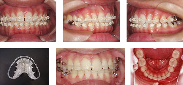 リテーナー（保定のための装置）の写真