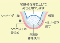 サイナスリフト