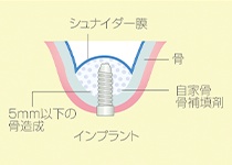 ソケットリフト