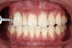 ホームホワイトニング治療後